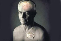 【健康解碼】起搏器真的能治好帕金森病嗎？